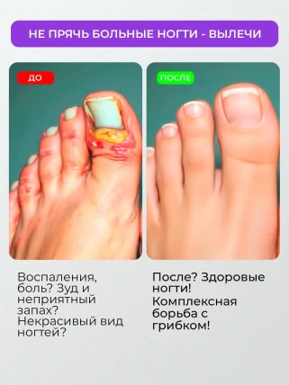 ФунгиСтоп — Где купить ФунгиСтоп, наличие и цены в аптеках